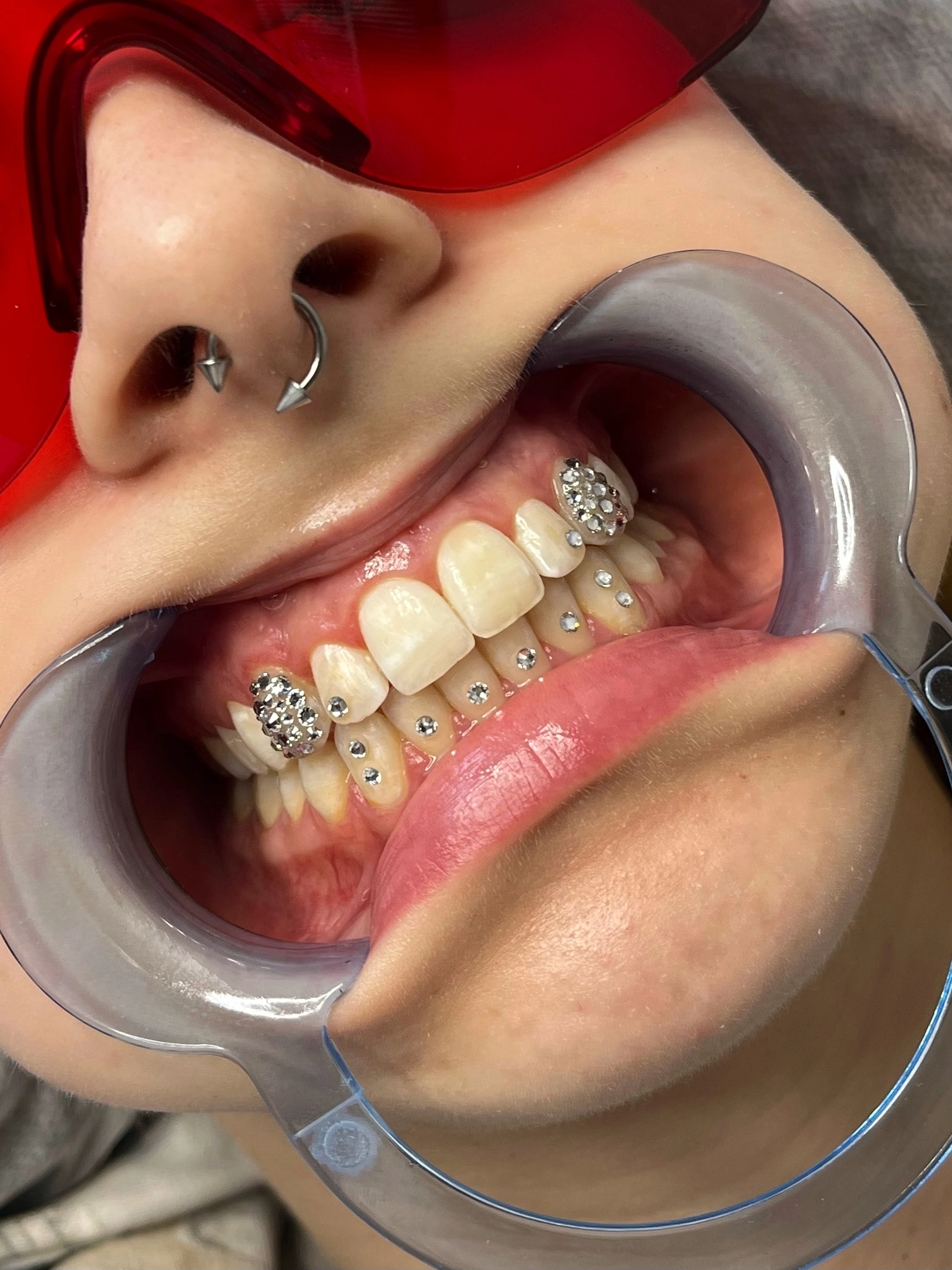 Efekt Toothgems - biżuteria nazębna