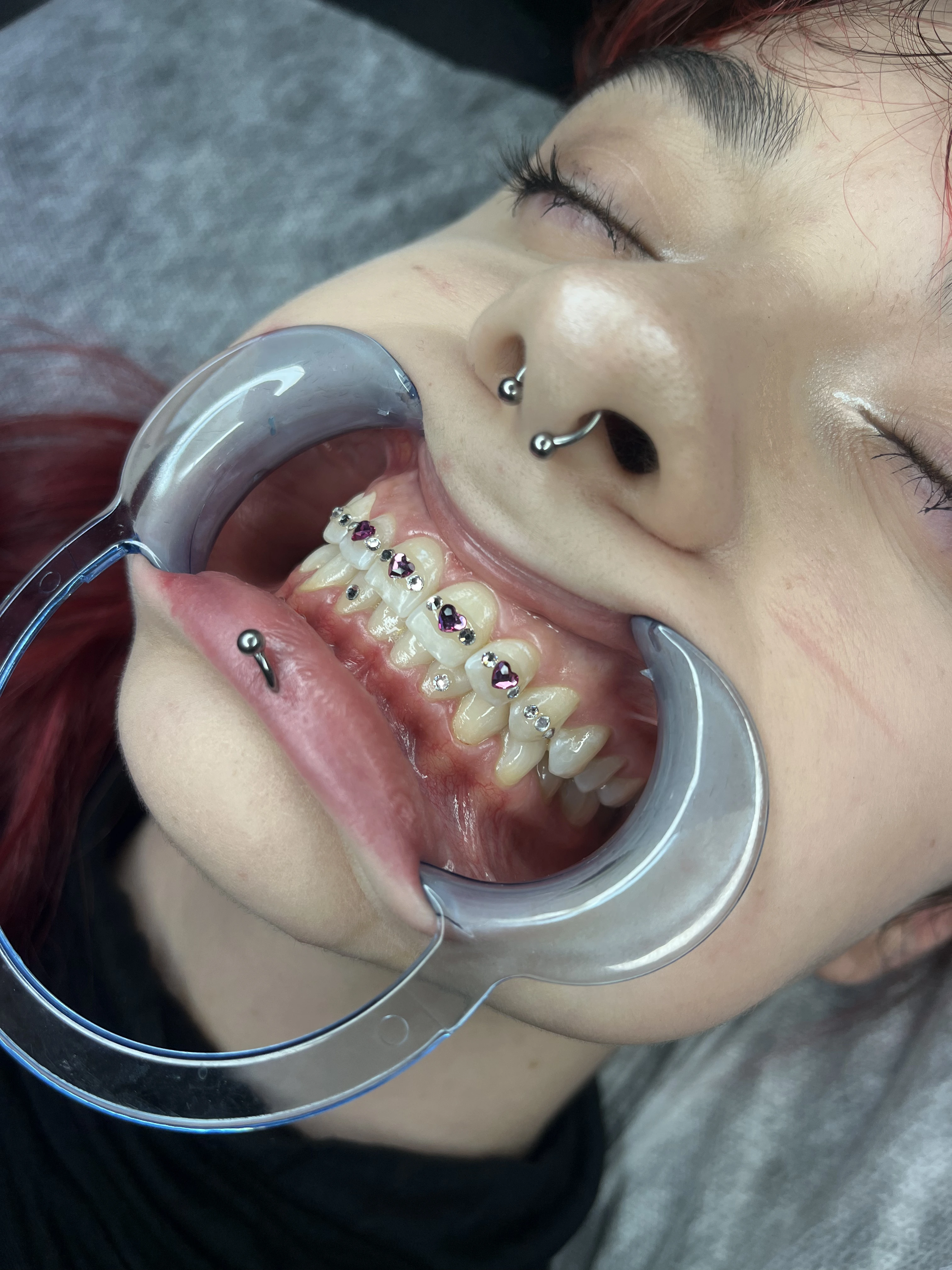 Efekt Toothgems - biżuteria nazębna