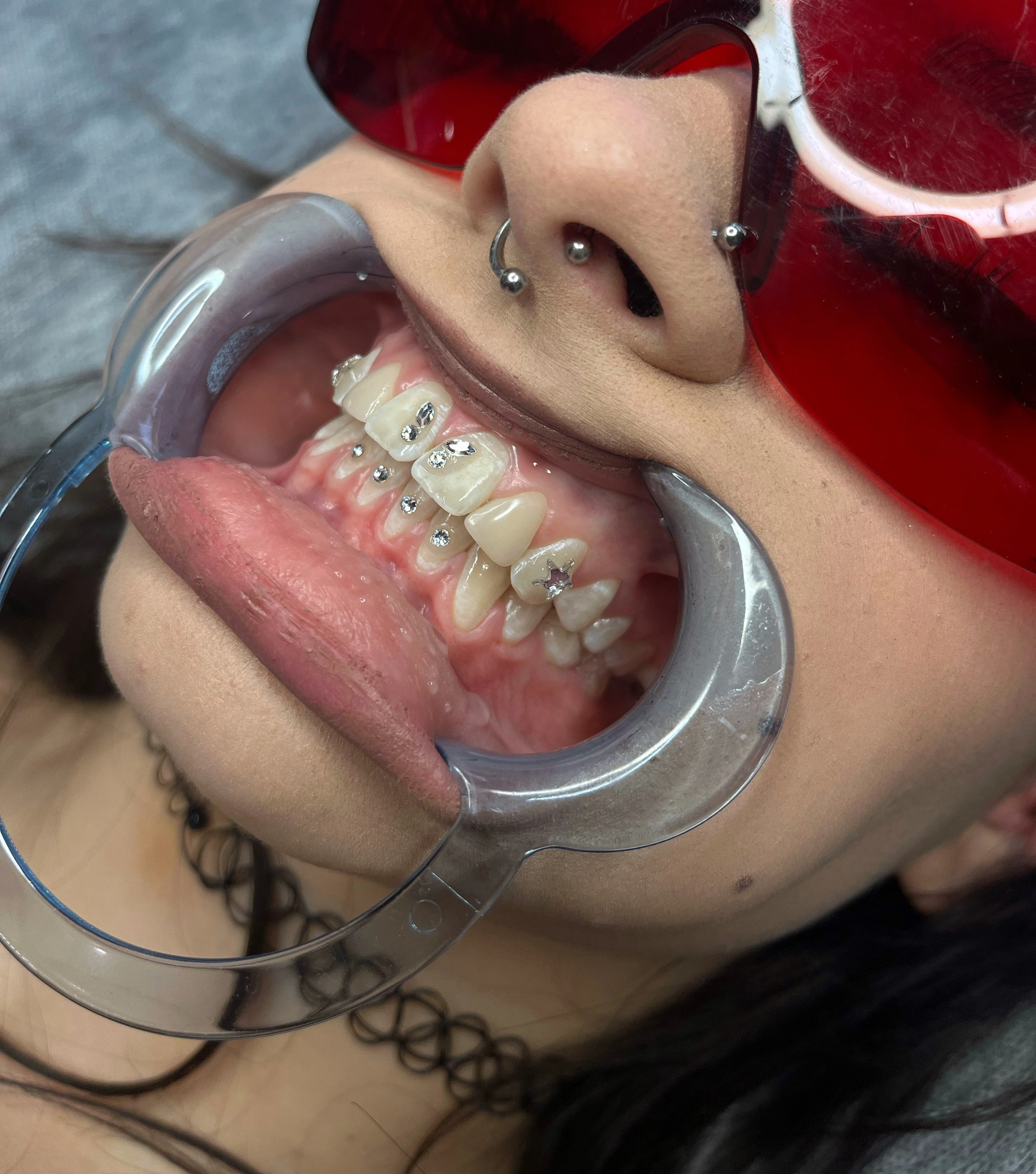 Efekt Toothgems - biżuteria nazębna